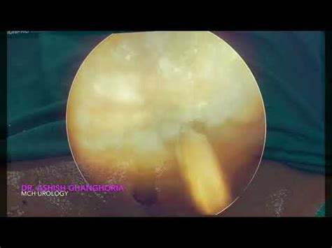 PCCL ( per cutaneous cystolithotripsy) - YouTube