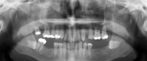 Tmd Imaging Of The Tmj Flashcards Quizlet