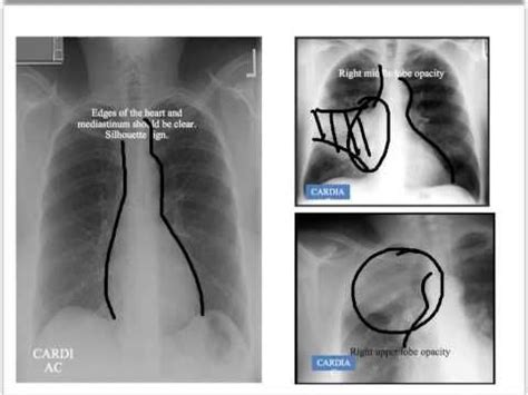 A Structured Approach To Interpretation Of The Chest X Ray This Goes