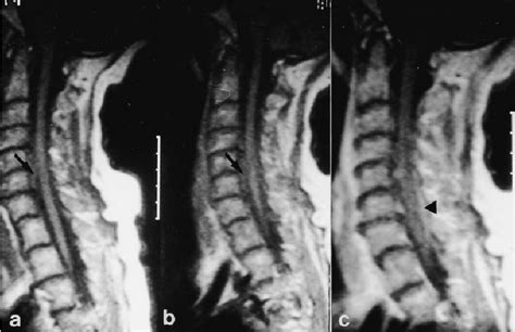 A B T Weighted Spin Echo Images Of The Cervical Spine