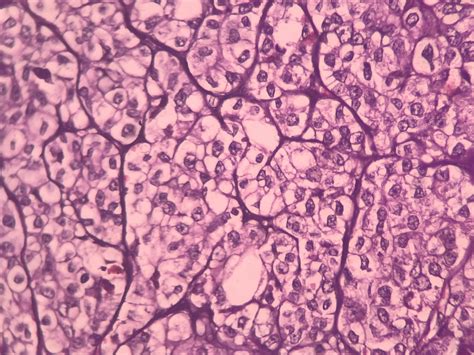 CLEAR CELL CARCINOMA OVARY Histopathology Guru