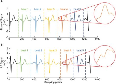 Frontiers Automatic Detection Of Atrial Fibrillation Based On