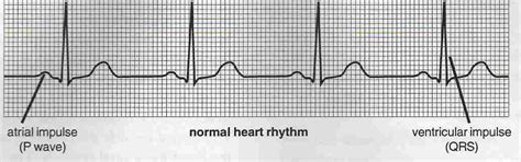 Sinus rhythm - wikidoc