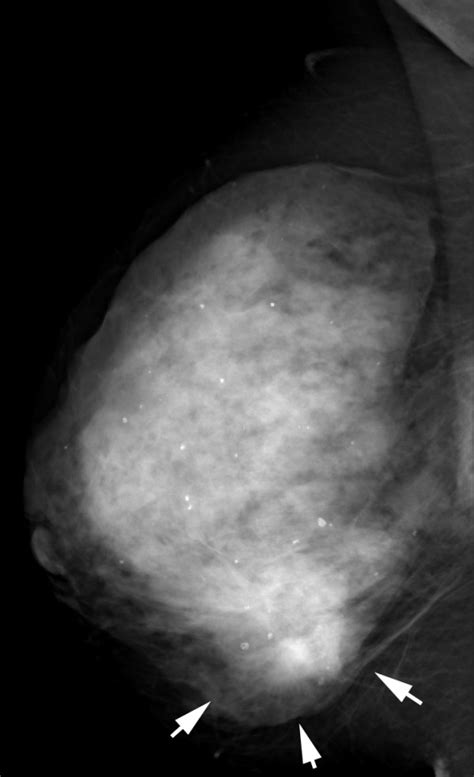 Multifocal Invasive Ductal Carcinoma In A 53 Year Old Woman With Dense