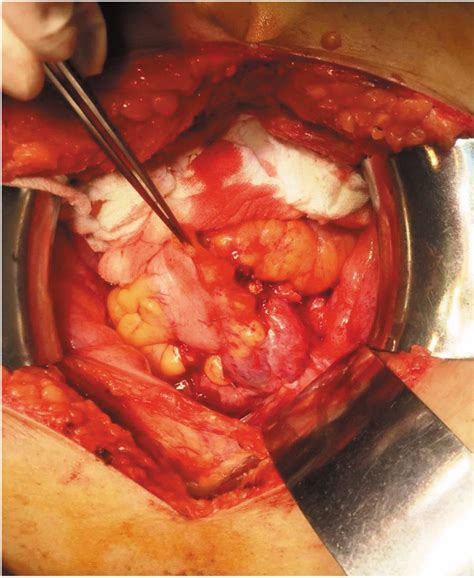 Figure Debulking Surgery For Pelvic Recurrence After Surgically