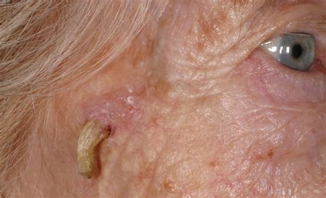 Actinic Keratosis Horn