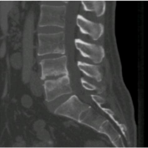 Ct Scan Of L3 L4 And L4 L5 Discs With Signs Of Degeneration And Download Scientific Diagram