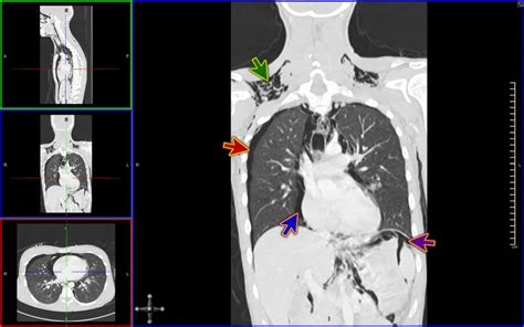 Contrast Ct Of Neck And Thorax Showing Pneumomediastinum Blue Arrow