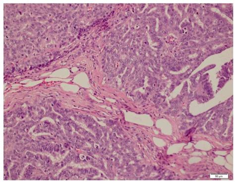 Figure 4 From Metastatic Serous Carcinoma Initially Presented As An