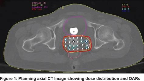 Figure 1 From Dose Optimization In Gynecological 3D Image Based