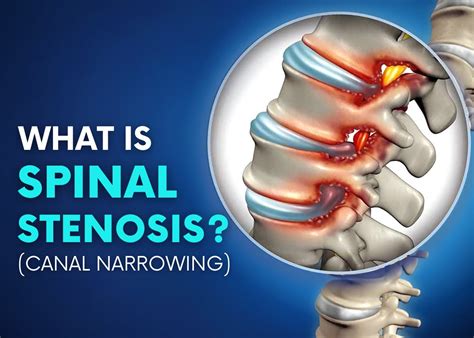 Spinal Stenosis Causes Symptoms Conventional And Holistic Treatments