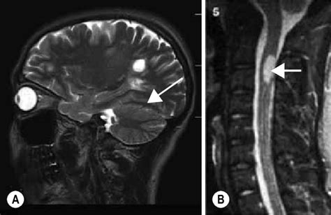 Cervical Spinal Cord Lesion MRI