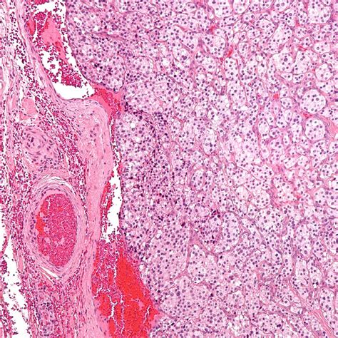 Neuroanatomy Glossary: Paraganglioma (eg, glomus jugulare paraganglioma