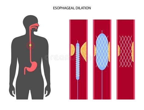 Esophageal Dilation Procedure Stock Vector Illustration Of Stenting