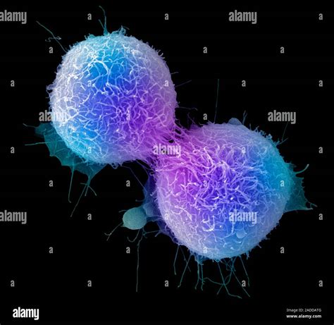 Dividing Cancer Cells Coloured Scanning Electron Micrograph Sem Of