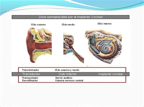 Hipoacusia Neurosensorial E Implante Coclear Dr Omar Gonzales Suazo