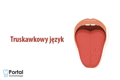 Truskawkowy język Portal Stomatologa