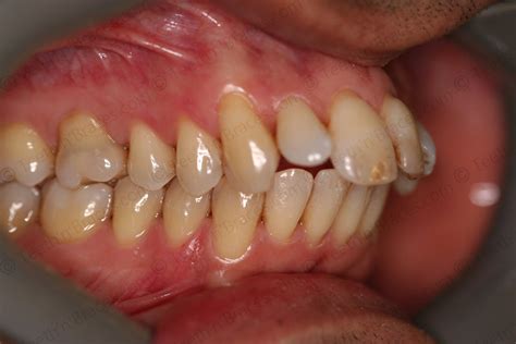 Case 8: Protruded and Irregular Teeth | Teeth N Braces