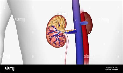 The Kidney Cancer, Stage III 3D rendering Stock Photo - Alamy