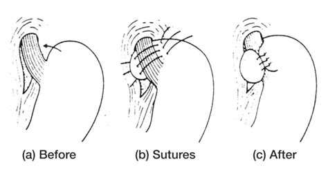 Stomach And Esophagus Before And After Nissen Fundoplication Operation