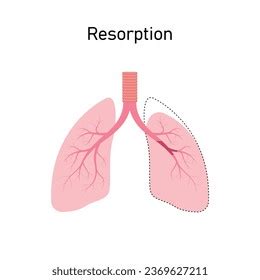 Atelectasis Pictures