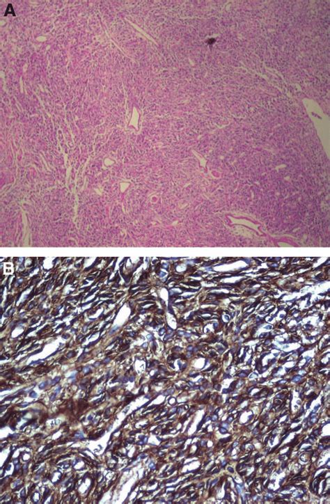 A The Tumor Composed Of Spindle Cells With Prominent Vascularity