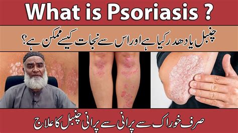 What Is Psoriasis Eczema Dhadar Chambal Aur Kharish Ka Ilaj Al