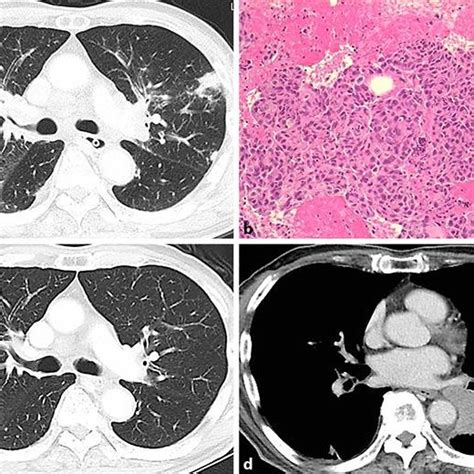 Initial Chest Computed Tomography CT And Microscopic Findings Of Lung