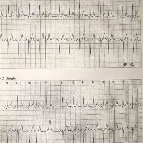 Arrhythmia Detected By Electrocardiography In Case 5 Download