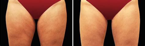 Velashape Before And After Vivalaser For You For All For Beauty