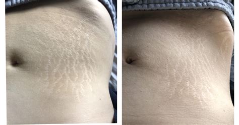 [Before&After] Been derma rolling for 4 months. Any difference? : r