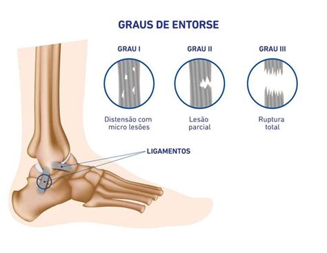 Entorse Do Tornozelo Imobilizador Ou Estabilizador De Tornozelo