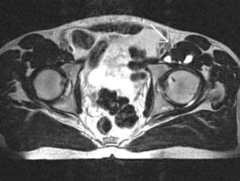 Iliopsoas Bursitis/ Tenditis-MRI - Sumer's Radiology Blog