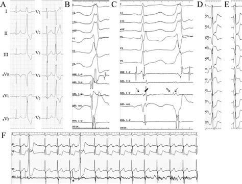 A Surface 12 Lead Electrocardiogram Recorded During Sinus Rhythm And