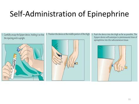 Ppt Chapter 53 Assessment And Management Of Patients With Allergic