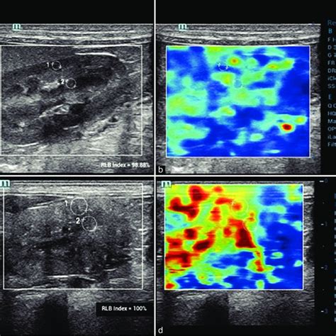 B Mode Ultrasound Images A And C And Color Quantitative Elastogram