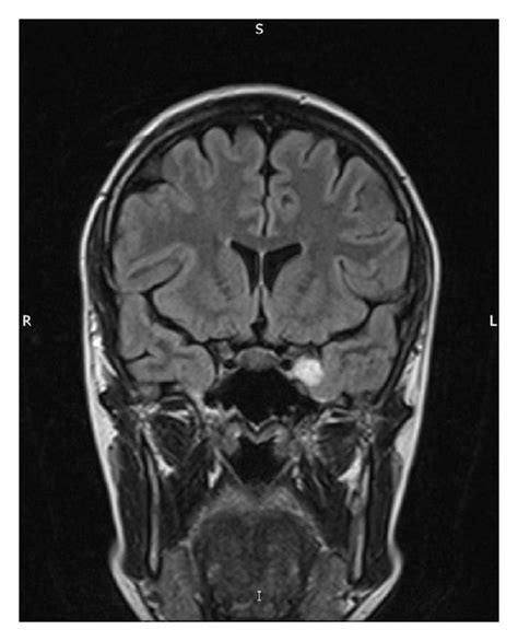 Cavernous Sinus Anatomy Mri