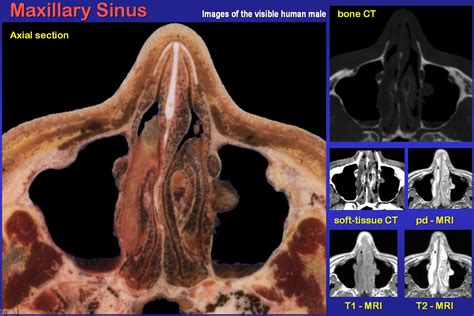 Frontal Sinus Anatomy 3D : They are the most superior of the paranasal ...