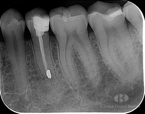 Tratamiento De Un Absceso Apical Agudo Mediante Cirugía Periapical