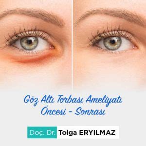 G Z Alt Torbas Ameliyat Ankara Do Dr Tolga Ery Lmaz