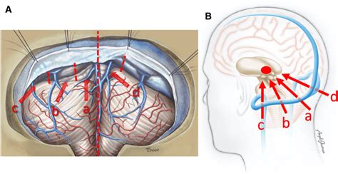 Illustrations Of The Infratentorial Supracerebellar Access To The Left