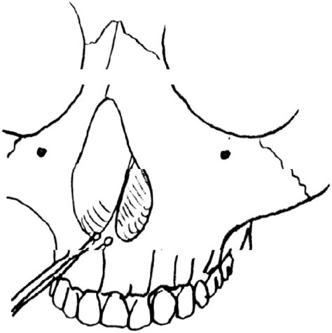 Figure 1 From Overview Of Surgical Treatment For Maxillary Constriction