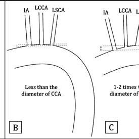 Schematic Diagrams Showing Ishimaru S Proximal Landing Zones Of