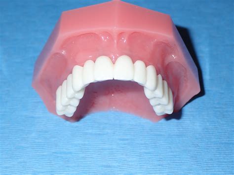 Mini Dental Implant Solutions | Columbus, OH | Lifetime Dental Health