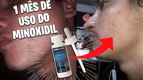 RESULTADO INCRÍVEL 1 MÊS DE USO DO MINOXIDIL YouTube