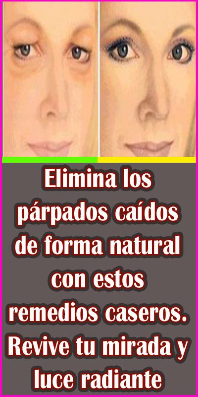 Elimina los párpados caídos de forma natural con estos remedios caseros