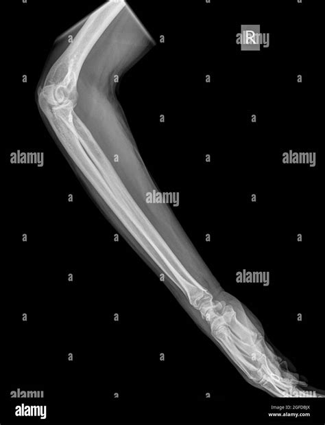 Fractura Radio Distal Anatomia Fotografías E Imágenes De Alta