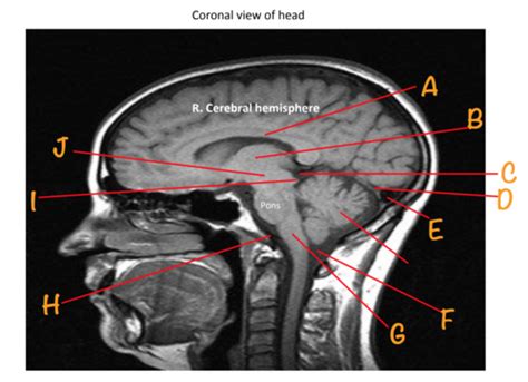 Sectional Anatomy Head CT Flashcards | Quizlet