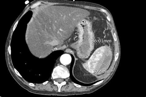 Subcapsular Haematoma Of The Spleen Complicating Acute Pancreatitis Bmj Case Reports