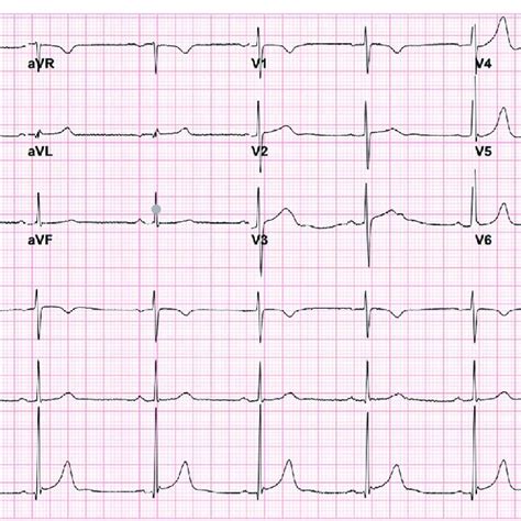 Twelve Lead Electrocardiogram Bradycardic Sinus Arrhythmia With A